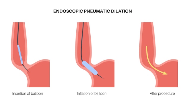 Vector endoscopic pneumatic dilation upper endoscopy minimally invasive procedure disorder of the esophagus therapy for achalasia balloon disrupts the muscle fibers in closed lower esophageal sphincter