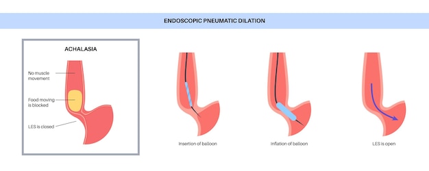 Dilatazione pneumatica endoscopica endoscopia superiore procedura minimamente invasiva disturbo della terapia dell'esofago per acalasia il palloncino interrompe le fibre muscolari nello sfintere esofageo inferiore chiuso