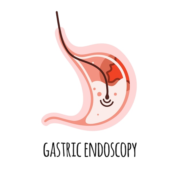 Endoscopie De maag van een persoon met een maagzweer Gastro-enterologie Vectorillustratie in een flat