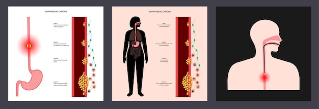 Vector esophageal carcinoma concept