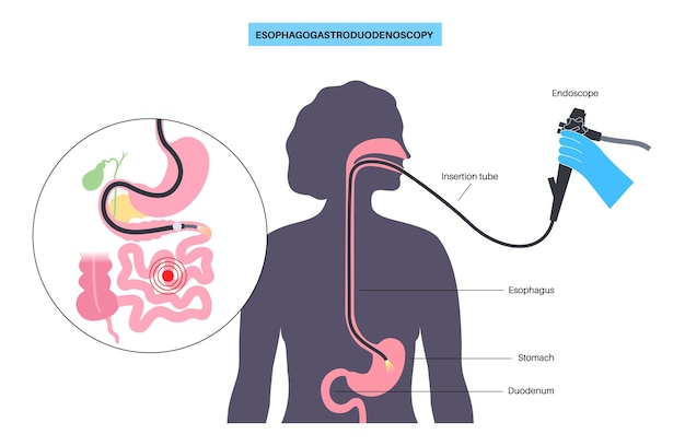 Poster medico esofagogastroduodenoscopia procedura diagnostica endoscopica minimamente invasiva visualizzazione dello stomaco dell'esofago e del duodeno prossimale illustrazione vettoriale piatta della gastroenterologia