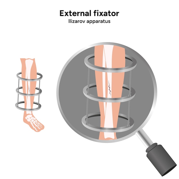 Vector external fixator llizarov apparatus zoom