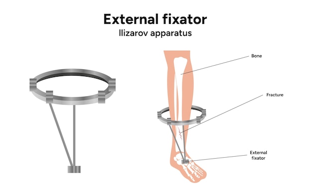 Vector external fixator llizarov apparatus