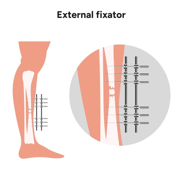 Externe fixator llizarov apparaat zoomzijde