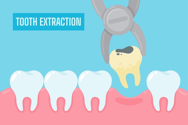 Estrazione dei denti. cartoon denti gialli con tartaro e placca rimossi dalla cavità orale.