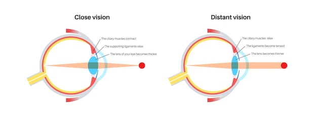 Vector eye accommodation poster