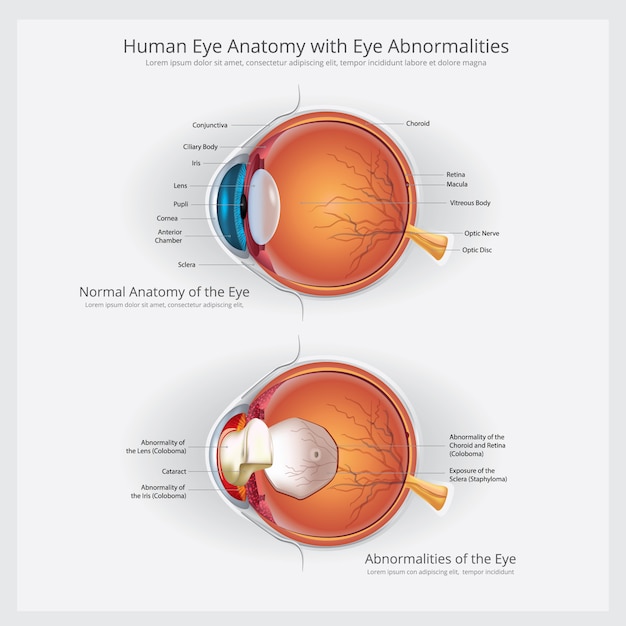 Vettore anatomia dell'occhio con l'illustrazione di vettore di anomalie dell'occhio