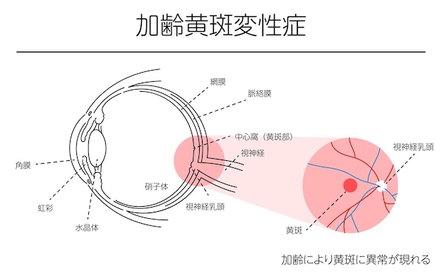 Vector eye disease agerelated macular degenillustration of eye disease agerelated macular degeneration