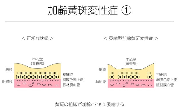 벡터 눈 질환 위축 연령관련 황반 변성 설명