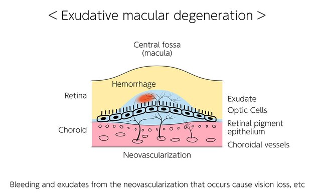 Vettore malattia dell'occhio degenerazione maculare essudativa legata all'età illustrata