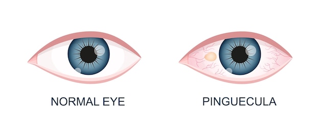 Vettore occhio sano e con pinguecola degenerazione congiuntivale prima e dopo l'intervento chirurgico