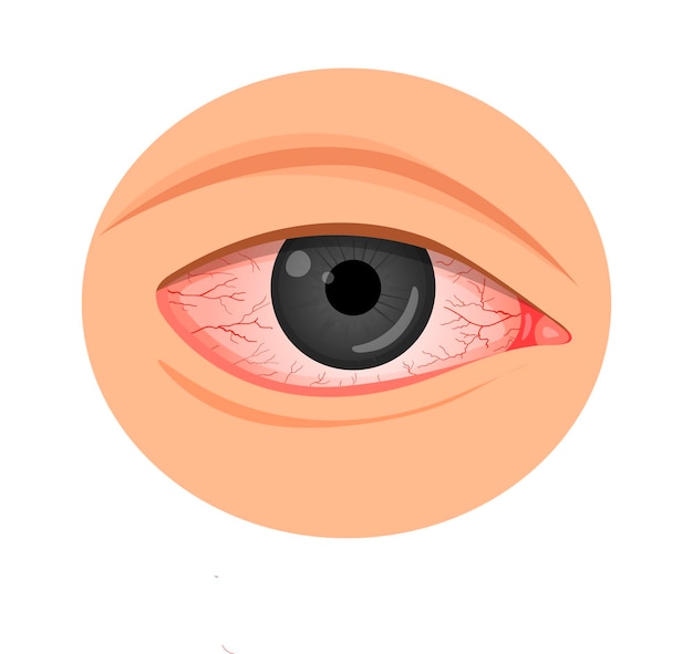 Eye irritation. konyuktevitis, keratitis, allergies, uveitis.