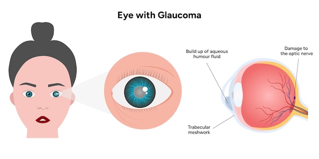 Eye with glaucoma disease medical infographic with human eye optic anatomy