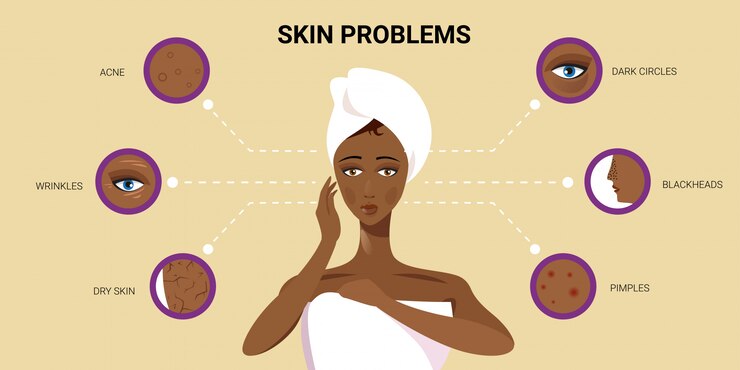 Vector facial skin pimples acne different types on african american woman face pore comedones cosmetology skincare problems concept flat portrait horizontal