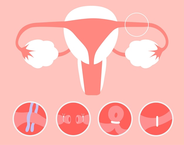 Vector fallopian tube ligation