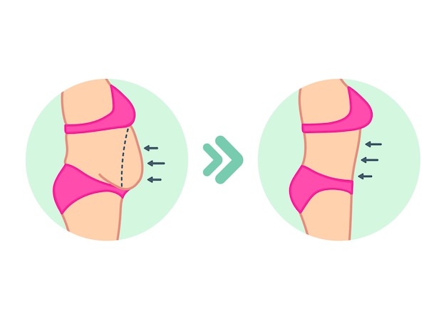 Vector fat on belly tummy before and after diet fitness or liposuction