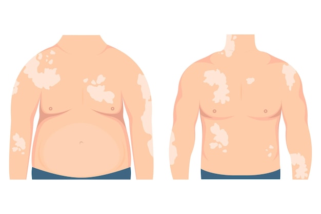 Vettore uomo grasso e magro con macchie di vitiligine sulla pelle. concetto di diversità di bellezza, corpo positivo, cronico