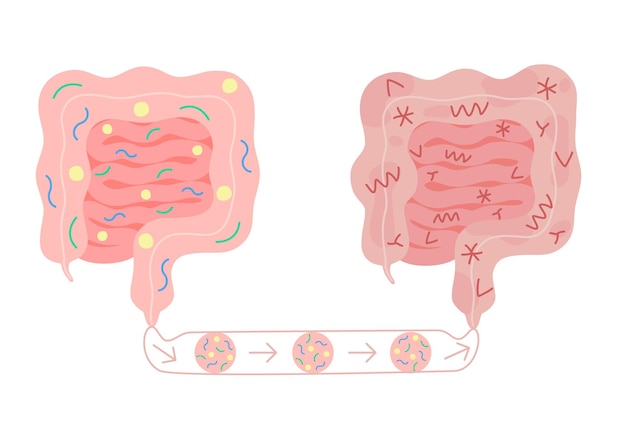 Fecal microbiota transplant from healthy in unhealthy intestine improvement intestinal microflora