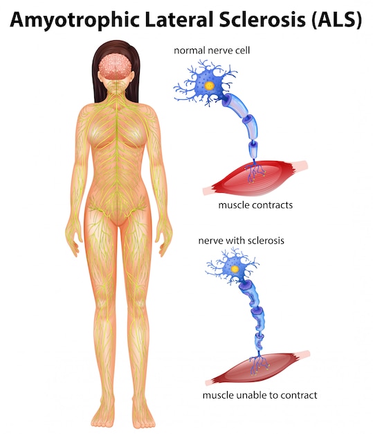 Female amyotrophic lateral sclerosis