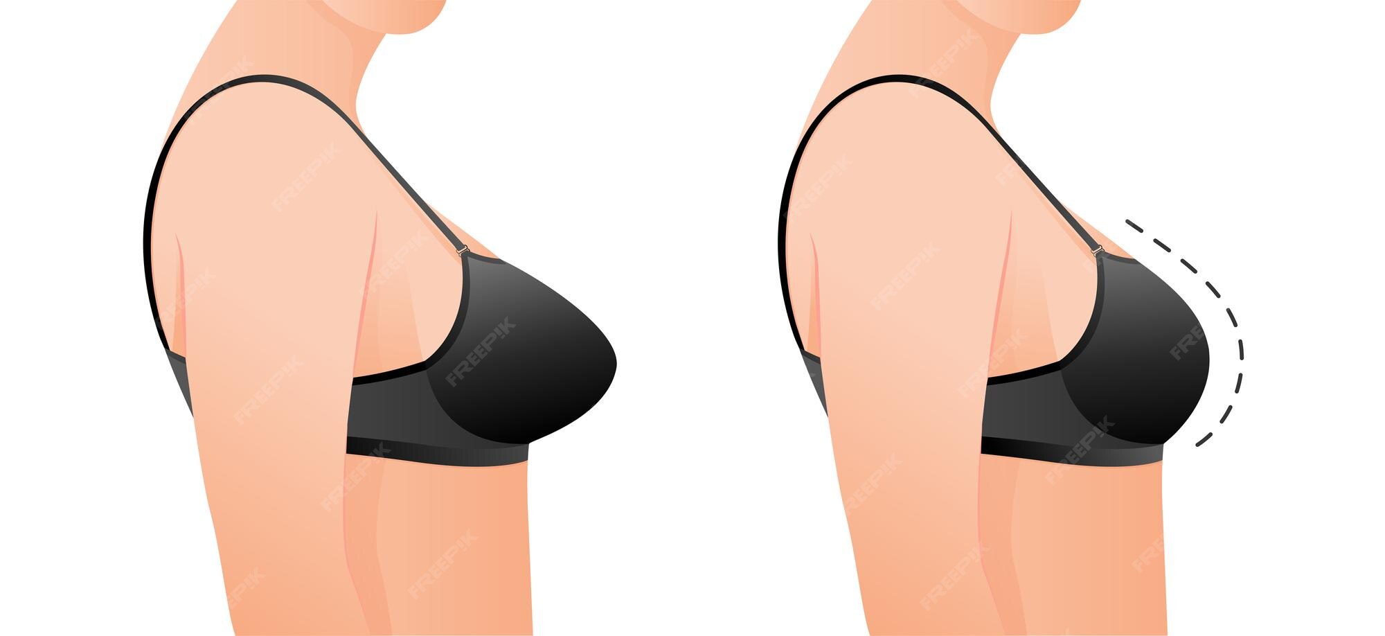 How Much Does Breast Reduction Surgery Cost In India