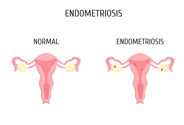 Vettore organi genitali femminili con e senza endometriosi infografica