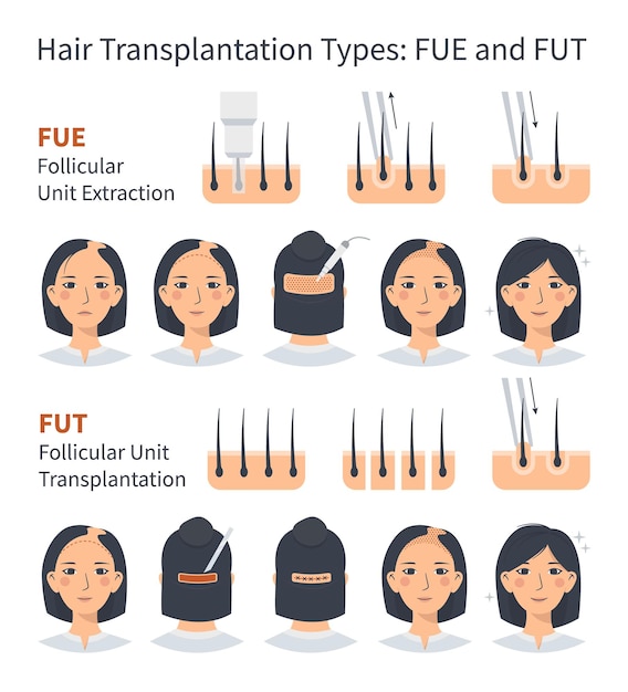 Vector female hair transplantation fue and fut stages and treatment of alopecia