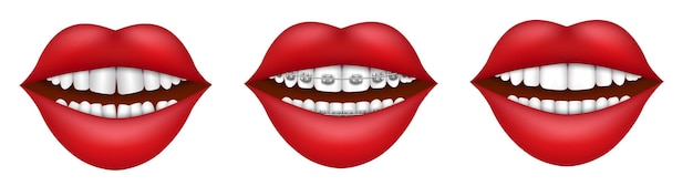 Vector female mouth with dental braces crooked and straight teeth