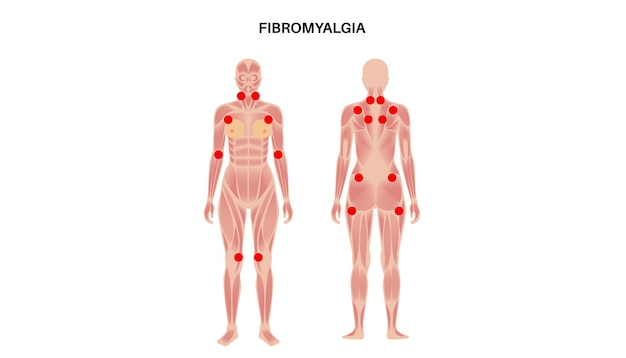 Vettore poster medico per la fibromialgia