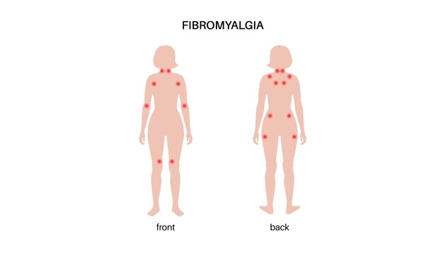 Vettore poster medico per la fibromialgia