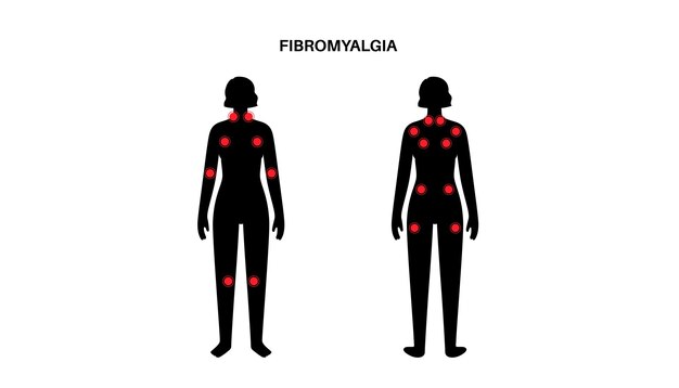 Vettore poster medico per la fibromialgia