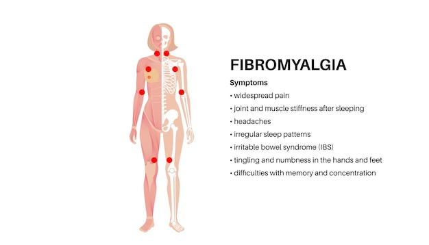 Vettore poster medico per la fibromialgia