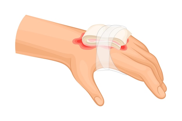 벡터 부스션 또는 피부 에 화상을 입은 사람 의 손 에 대한 응급 처치