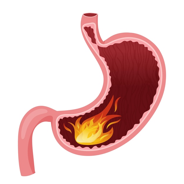 Vector flame in human stomach illustration