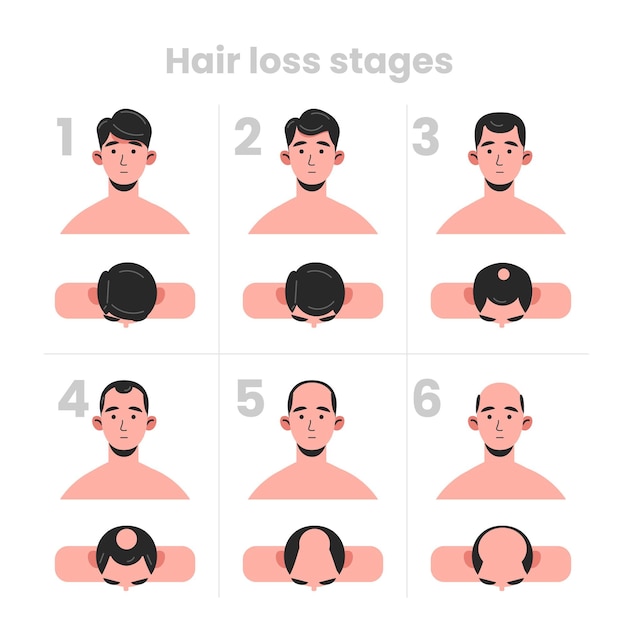 Vector flat-hand drawn hair loss stages