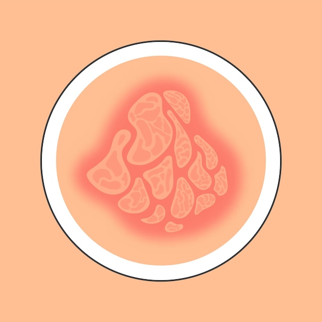 Flat Style Eczema Disease Skin Circle Icon In Red And Peach Color