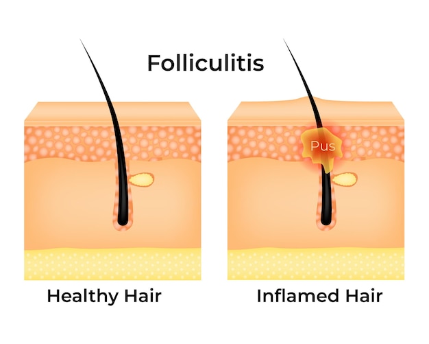 Folliculitis gezondheid haar en ontstoken haar vector illustratie