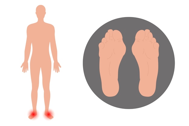 Vector foot deformation in human