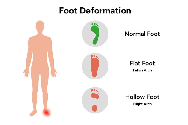Деформация ноги