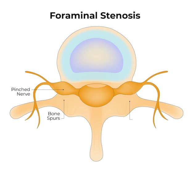 Foraminale stenose knepen zenuw bot sporen vector illustratie