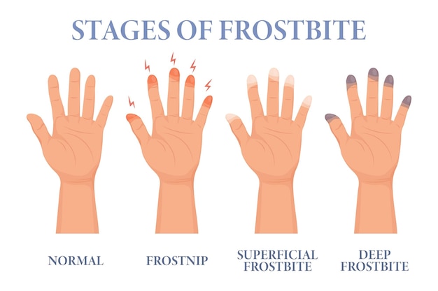 Frostbite stages. Frozen hands in different stages. Medical frostbite. Skin burn symptom.Health care