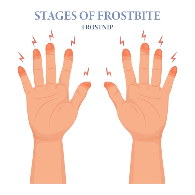 Frozen hands in different stages. Medical frostbite. Stages of frostbite of fingers. Skin burn