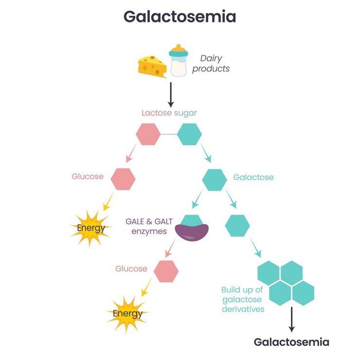 Vector galactosemia gale galt enzyme deficiency science vector illustration infographic