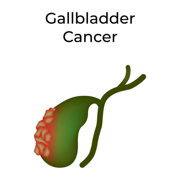 Vector gallbladder cancer vector illustration