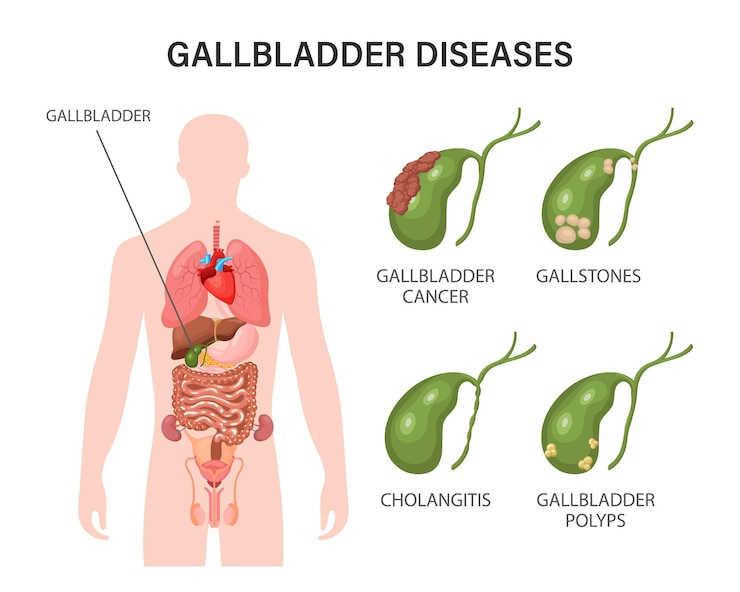 Vector gallbladder diseases infographics gallstone disease cancer acute cholecystitis cholangitis