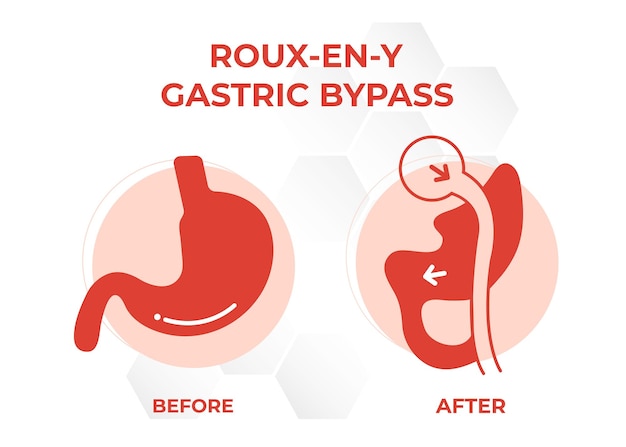 Vector gastric bypass rny weight loss surgery vector illustration icon rouxeny