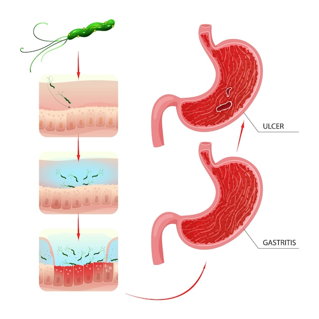 Vector gastritis and ulcer development process in stomach