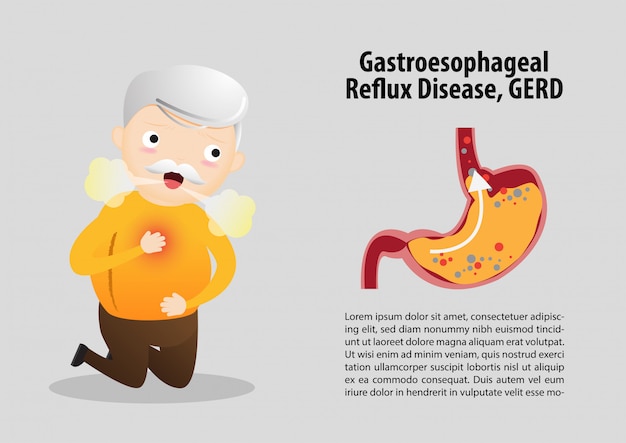 Vettore modello di malattia da reflusso gastroesofageo (gerd)