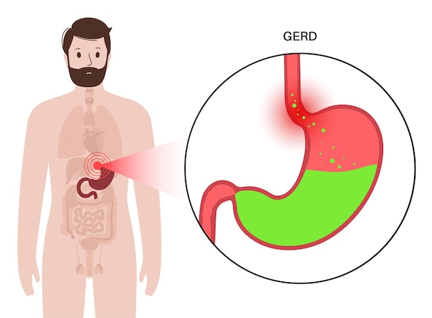 Gastro-oesofageale refluxziekte poster. Spijsverteringsstoornis en GERD-probleem in het menselijk lichaam. Pijn, brandend maagzuur in borst, maag en slokdarm. Open sluitspier maakt zure reflux platte vectorillustratie mogelijk.