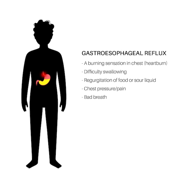 Malattia da reflusso gastroesofageo. bambino in clinica. disturbi digestivi e gerd nel corpo del bambino. dolore, bruciore di stomaco al torace, allo stomaco e all'esofago. lo sfintere aperto consente l'illustrazione vettoriale piatta del reflusso acido