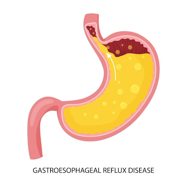 Vettore malattia da reflusso gastroesofageo e illustrazione del bruciore di stomaco